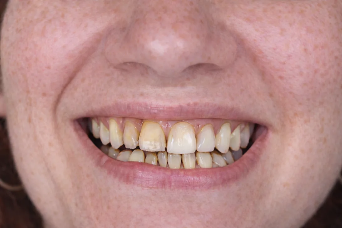Sonrisa antes del tratamiento
