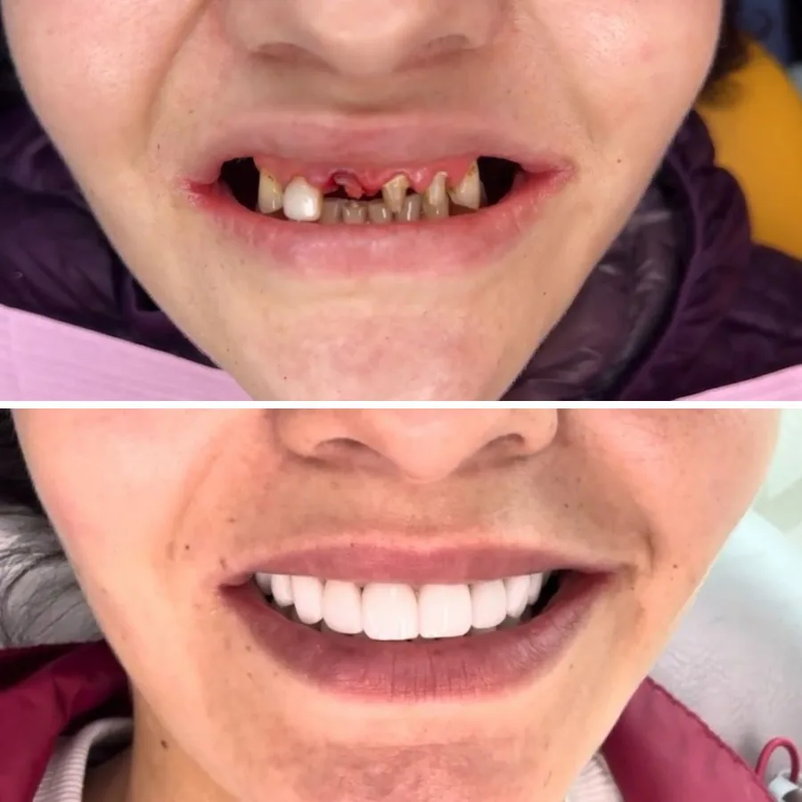 Antes y después de rehabilitación con implantes
