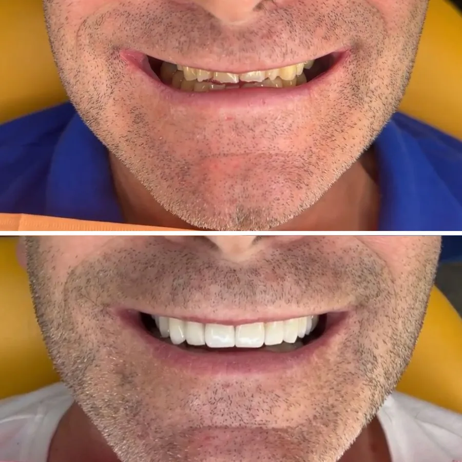 Antes y después de implantes dentales