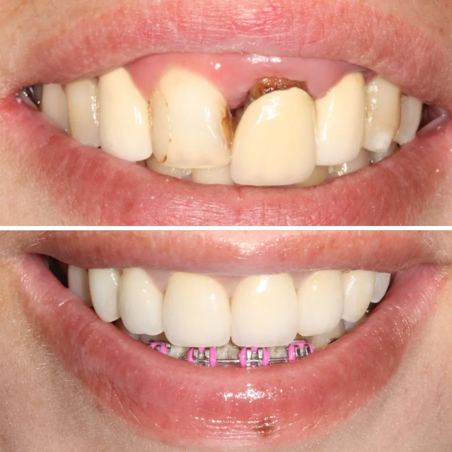 Antes y después de rehabilitación estética