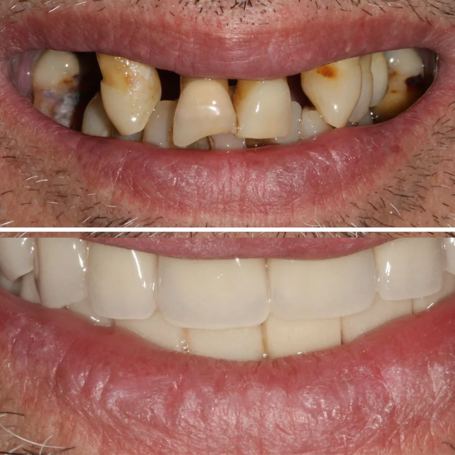 Antes y después de coronas y rehabilitación