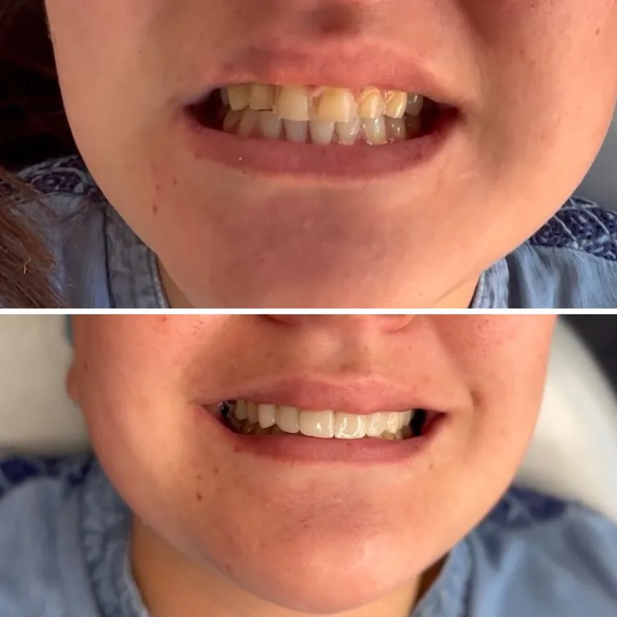 Antes y después de carillas