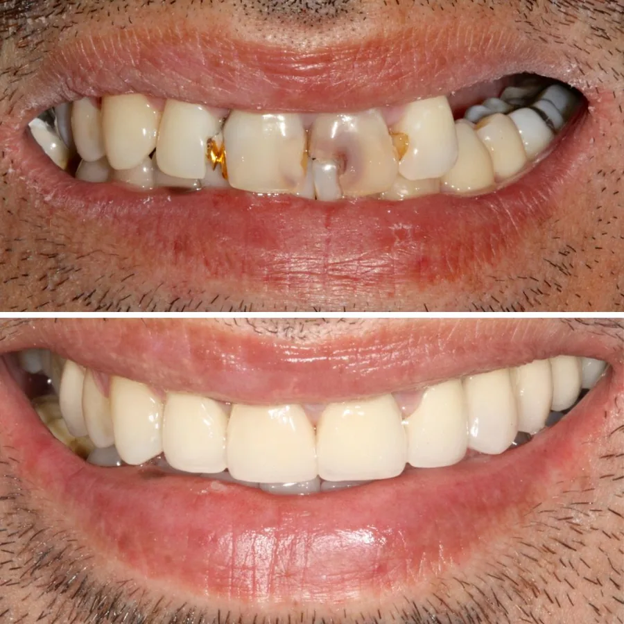 Antes y después de diseño de sonrisa