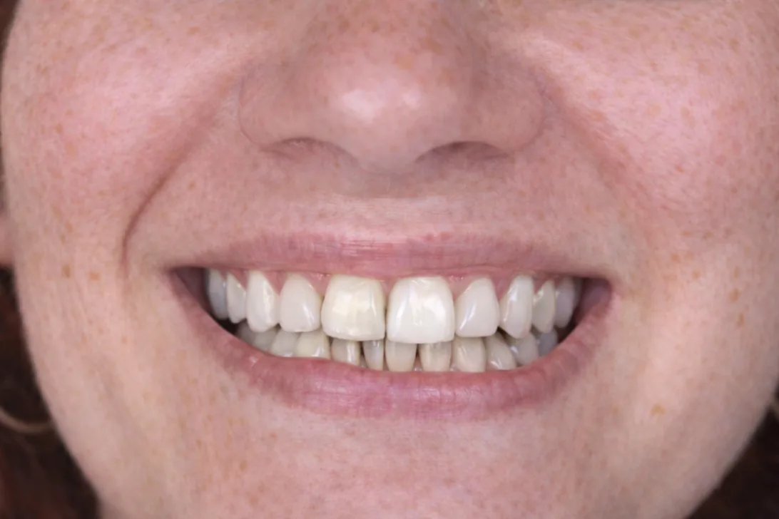 Sonrisa después del tratamiento en Clínica Implandent